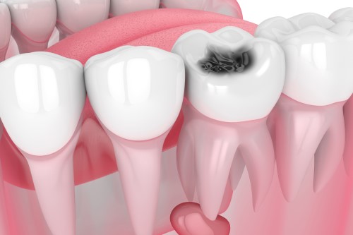 虫歯菌の酸により歯が溶かされる病気